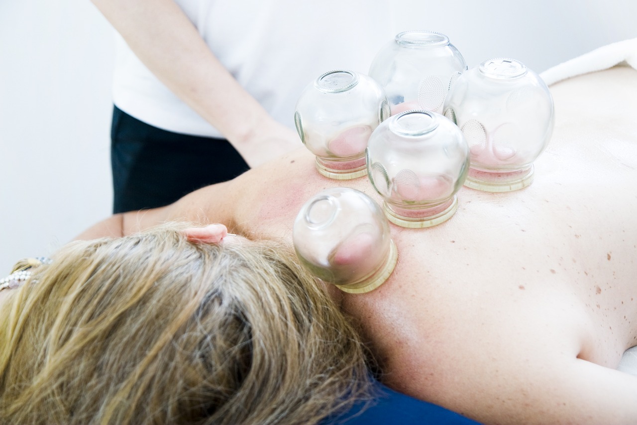 cupping therapy on back