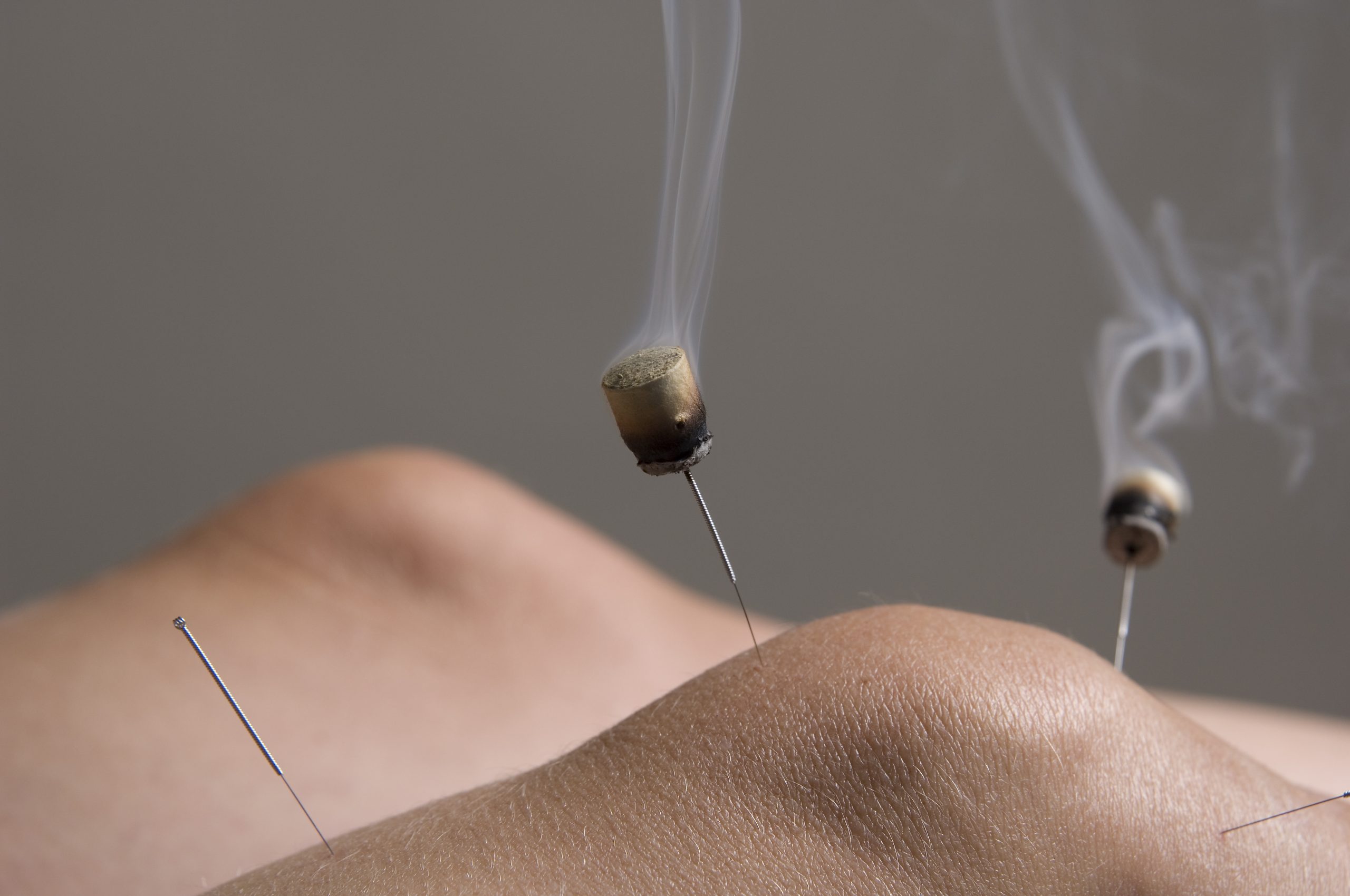 Acupuncture and Moxibustion for Knee Osteoarthritis